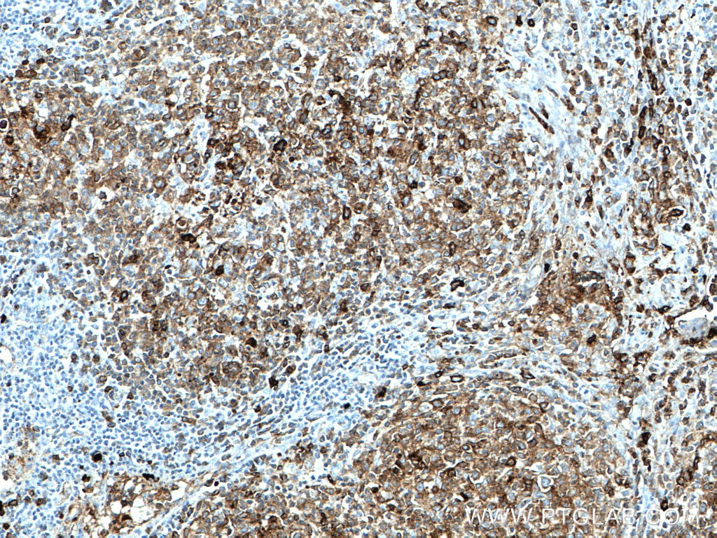 IHC staining of human lymphoma using 66484-1-Ig