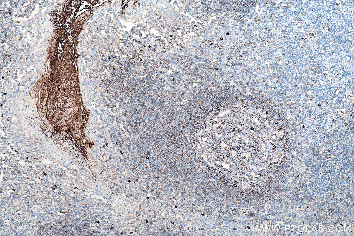 IHC staining of human tonsillitis using 66484-1-Ig Immunohistochemistry (IHC) staining of human tonsillitis tissue using human IgM Monoclonal antibody (66484-1-Ig)