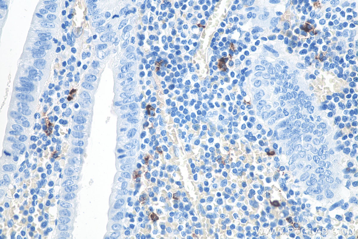 IHC staining of human appendicitis using 66484-1-Ig Immunohistochemistry (IHC) staining of human appendicitis tissue using human IgM Monoclonal antibody (66484-1-Ig)
