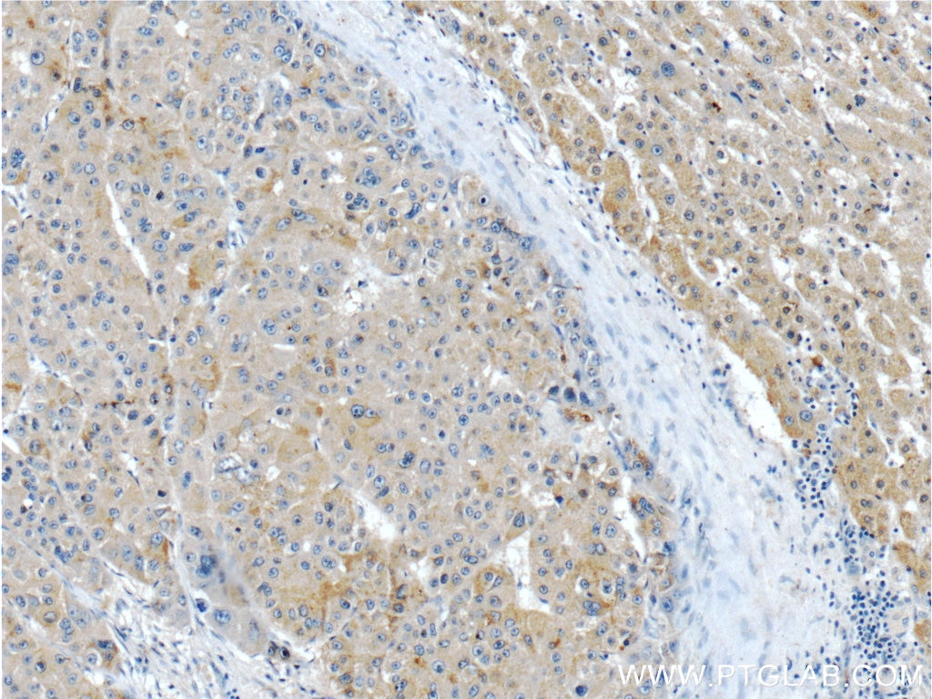 Immunohistochemistry (IHC) staining of human liver cancer tissue using IGHMBP2 Polyclonal antibody (23945-1-AP)