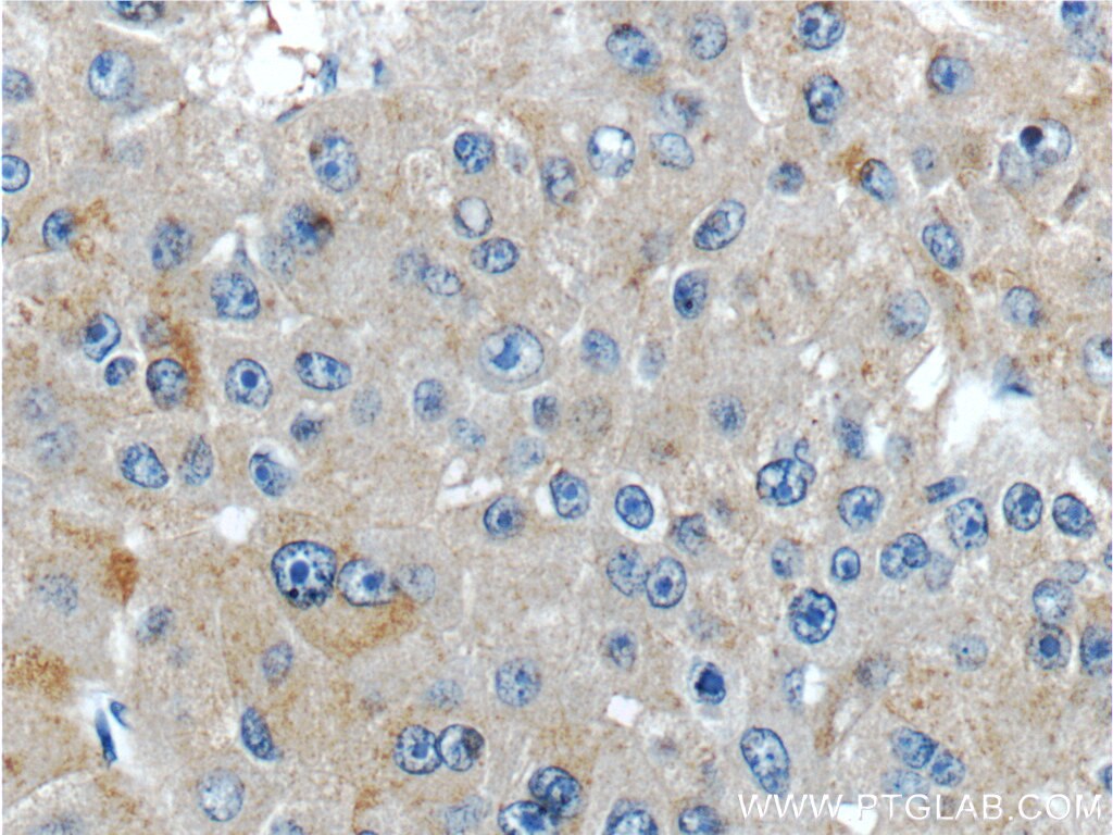 Immunohistochemistry (IHC) staining of human liver cancer tissue using IGHMBP2 Polyclonal antibody (23945-1-AP)