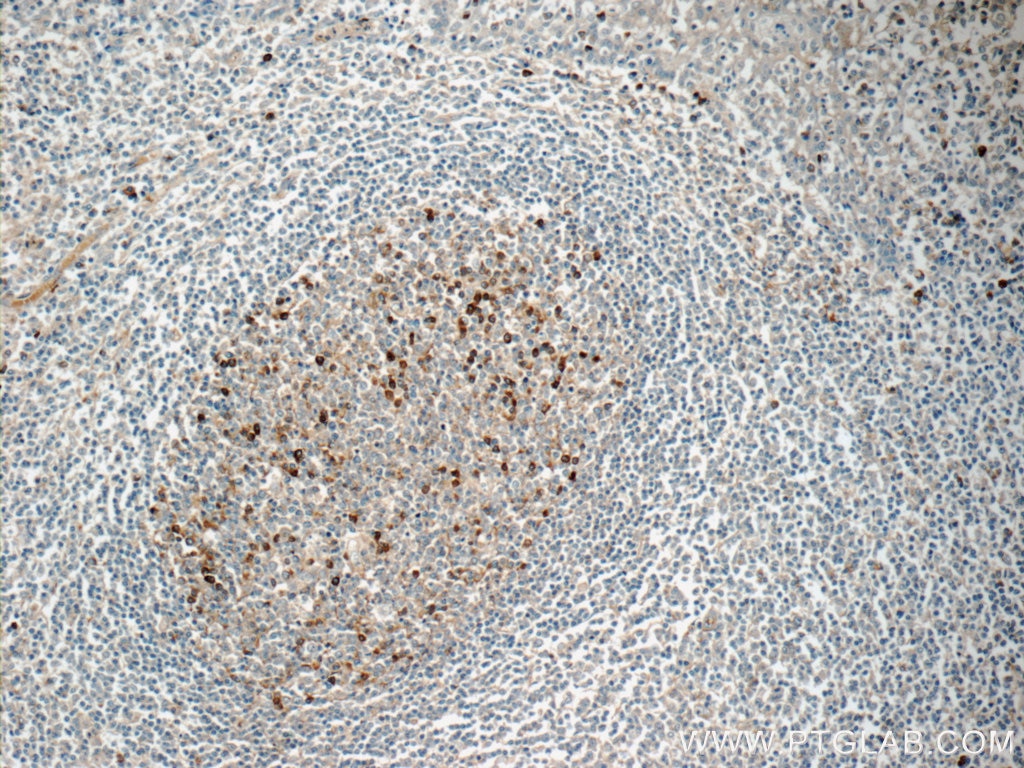 Immunohistochemistry (IHC) staining of human tonsillitis tissue using IGJ Polyclonal antibody (13688-1-AP)