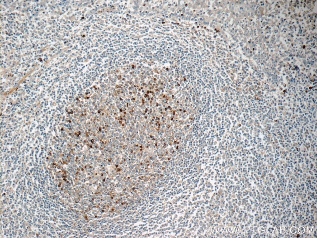 IHC staining of human tonsillitis using 13688-1-AP