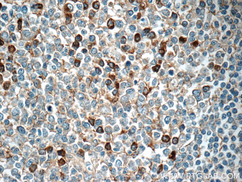 Immunohistochemistry (IHC) staining of human tonsillitis tissue using IGJ Polyclonal antibody (13688-1-AP)