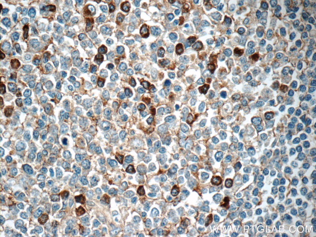 IHC staining of human tonsillitis using 13688-1-AP