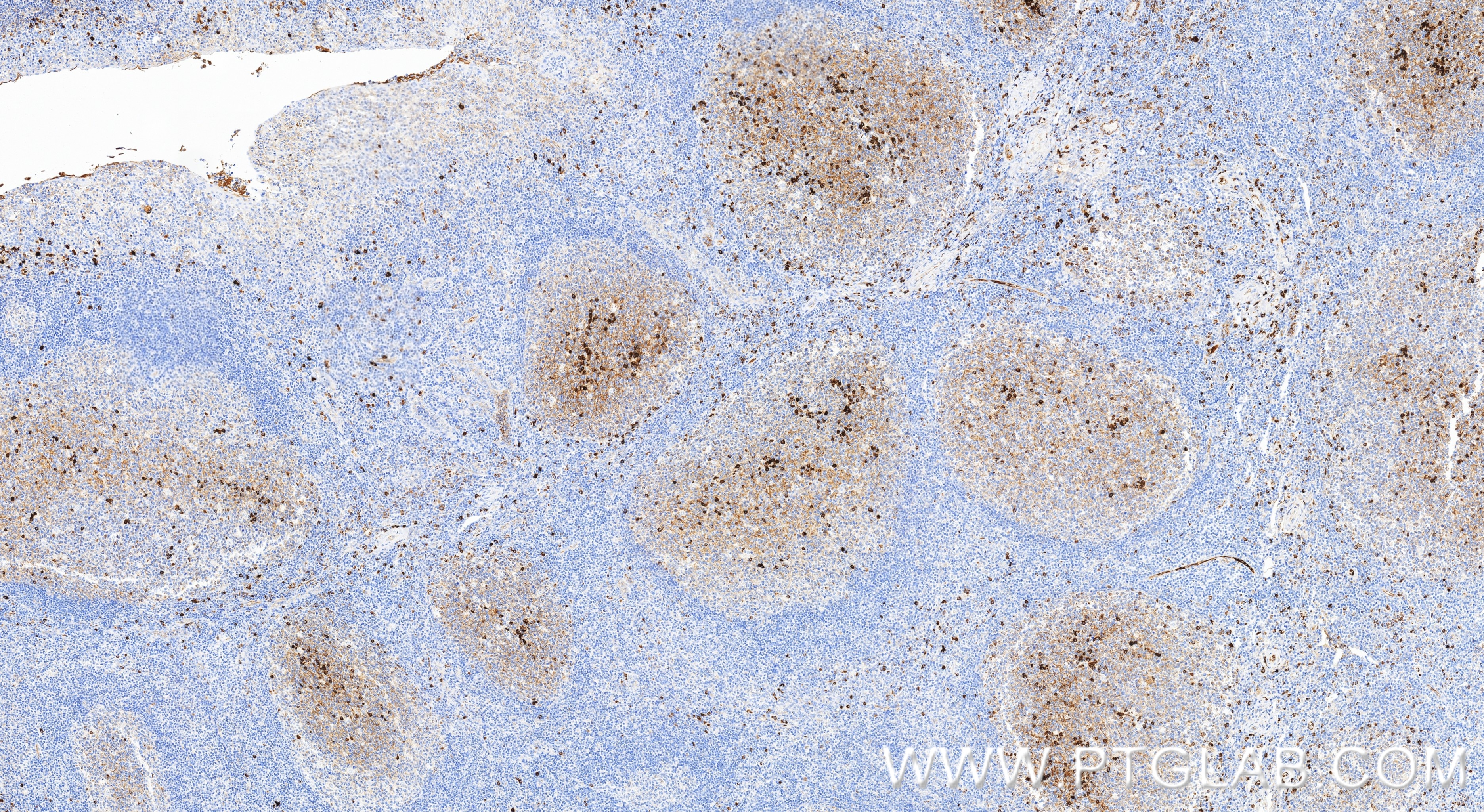 Immunohistochemistry (IHC) staining of human tonsillitis tissue using IGJ Recombinant monoclonal antibody (86939-1-RR)