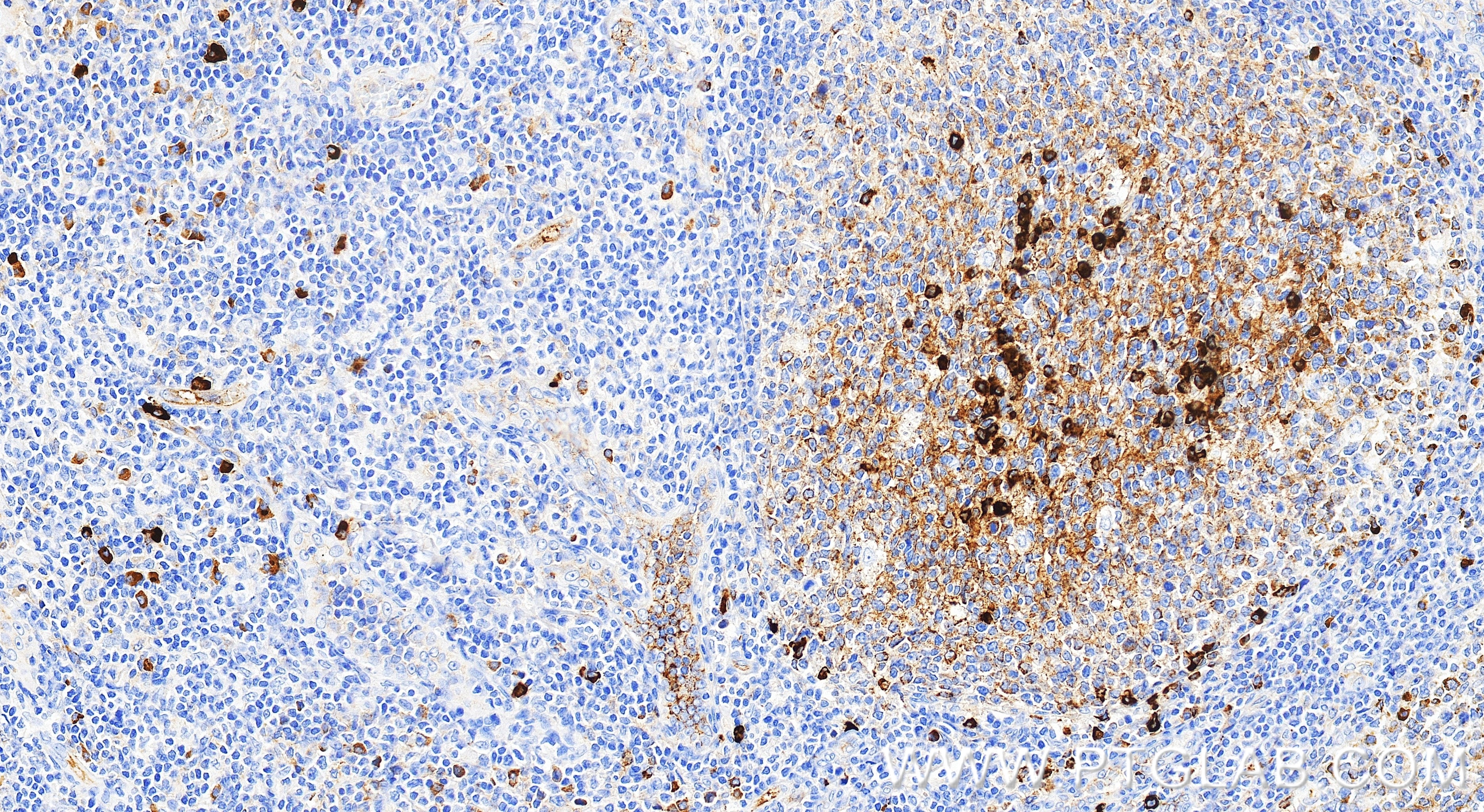 Immunohistochemistry (IHC) staining of human tonsillitis tissue using IGJ Recombinant monoclonal antibody (86939-1-RR)