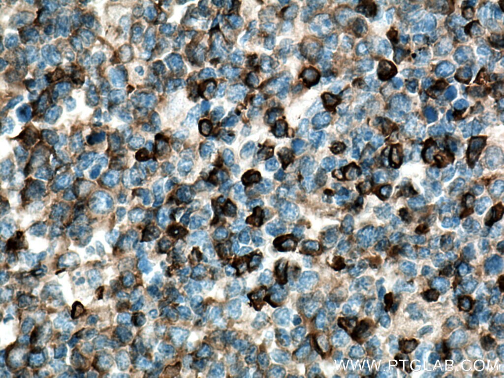 Immunohistochemistry (IHC) staining of human tonsillitis tissue using IgG Lambda Light Chain Polyclonal antibody (11541-1-AP)