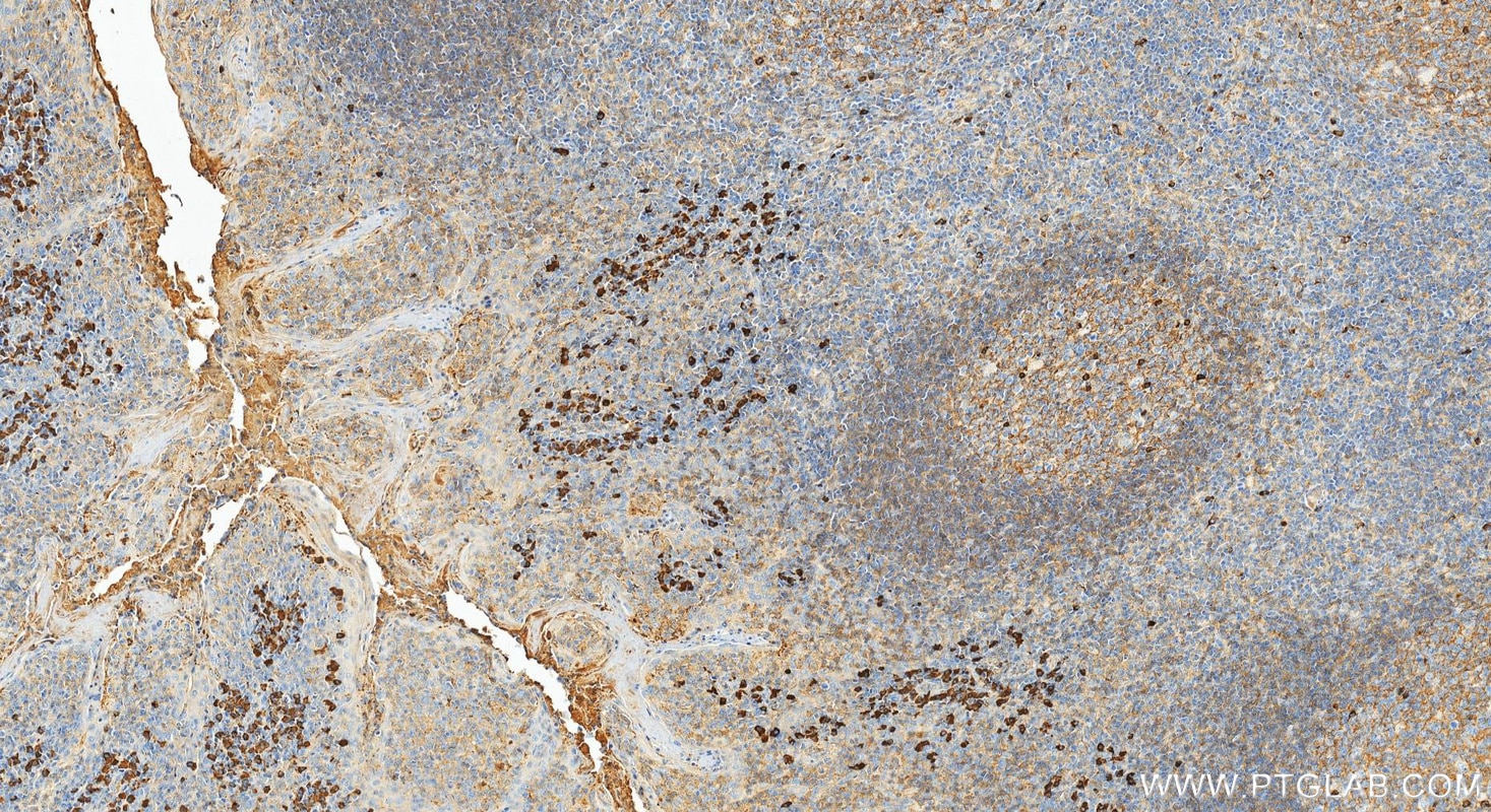 Immunohistochemistry (IHC) staining of human tonsillitis tissue using Ig Lambda Light Chain Polyclonal antibody (11541-1-AP)