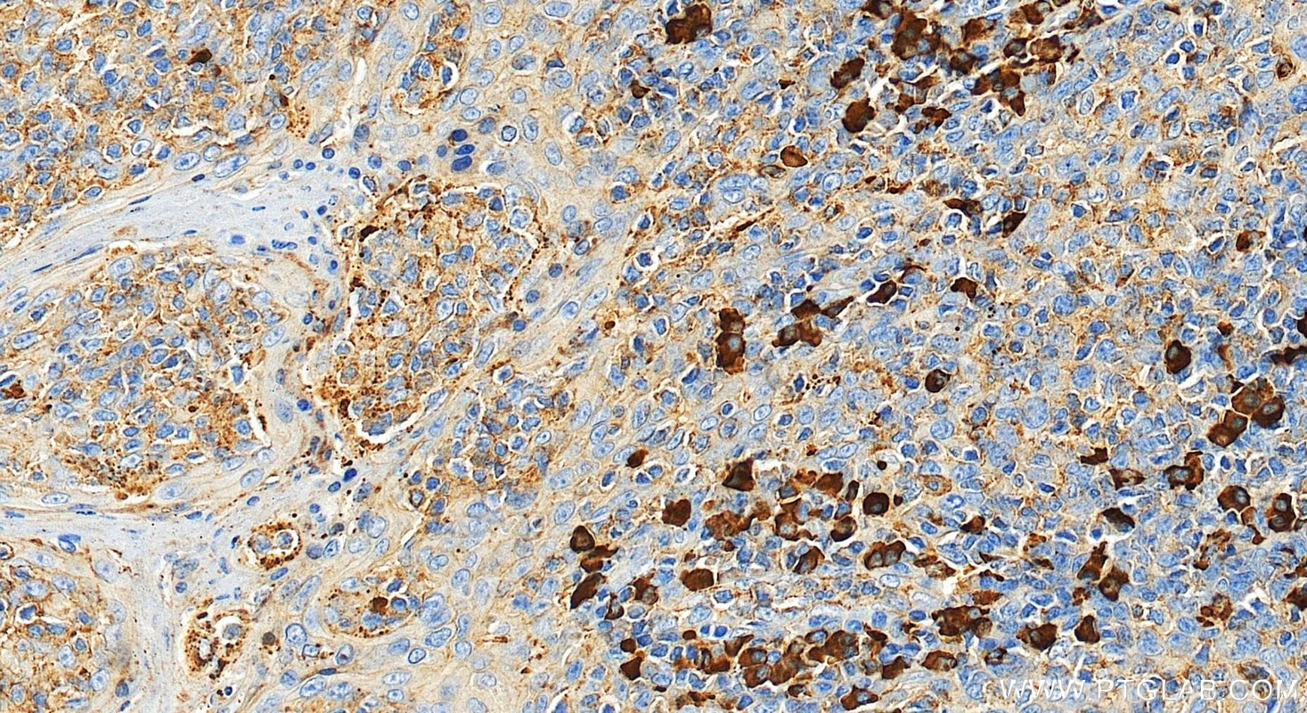 Immunohistochemistry (IHC) staining of human tonsillitis tissue using Ig Lambda Light Chain Polyclonal antibody (11541-1-AP)