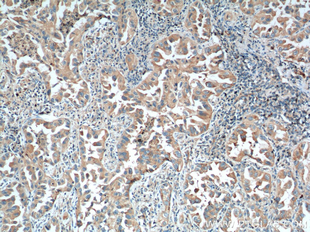 Immunohistochemistry (IHC) staining of human lung cancer tissue using IGSF2 Monoclonal antibody (66333-1-Ig)