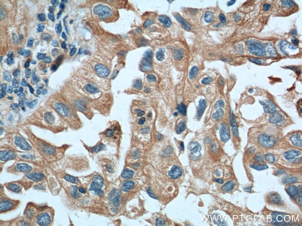 Immunohistochemistry (IHC) staining of human lung cancer tissue using IGSF2 Monoclonal antibody (66333-1-Ig)