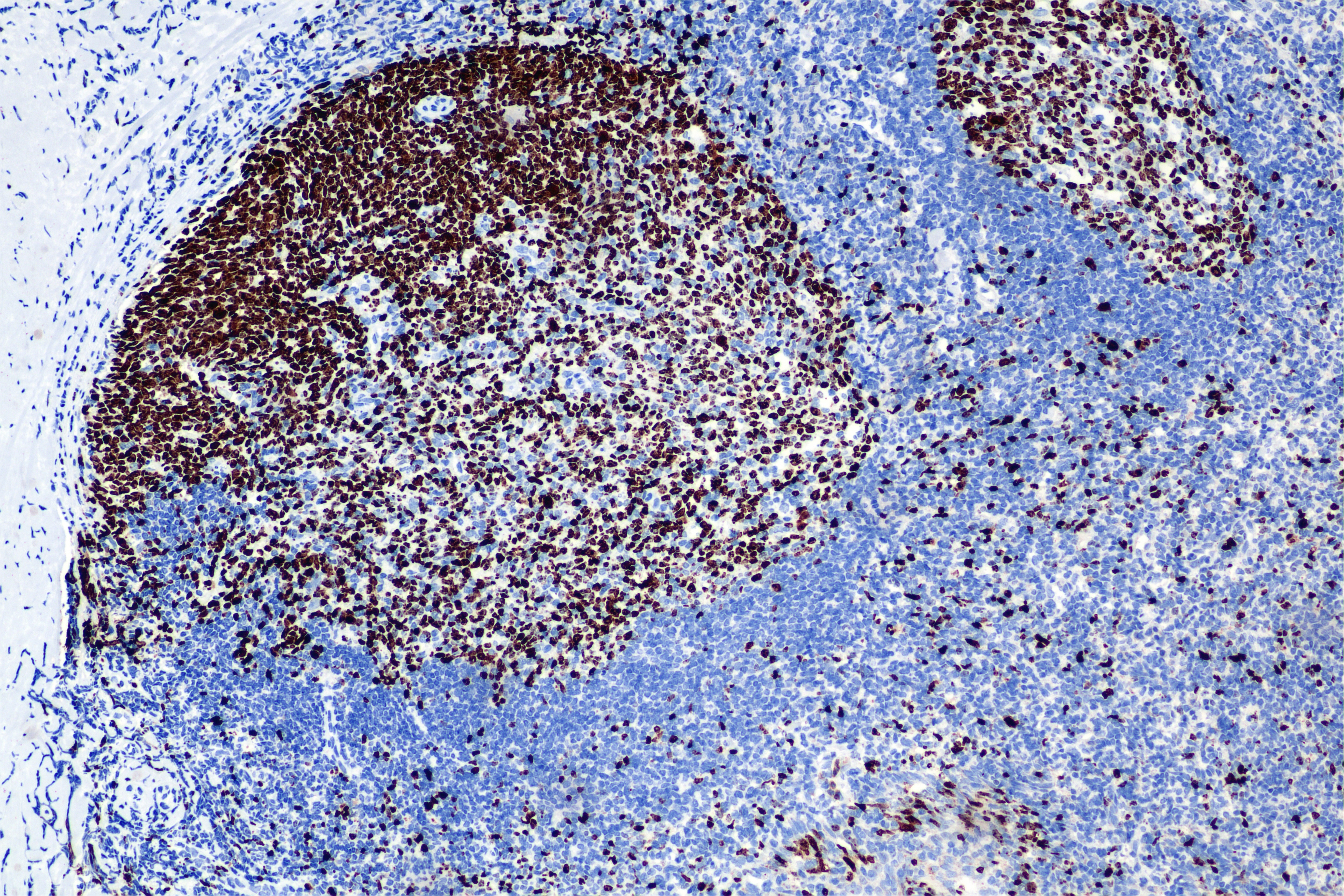 Immunohistochemical analysis of paraffin-embedded mouse heart tissue slide using HRP-PF00030 (HRP Streptavidin) at dilution of 1:500 (under 20X lens). Heat mediated antigen retrieval with Tris-EDTA buffer (pH 9.0).
一抗用的Biotin-conjugated Ki-67 Recombinant monoclonal antibody（批次：21024638）