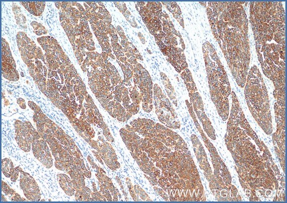 Immunohistochemical analysis of paraffin-embedded human oesophagus cancer tissue slide using anti-Cytokeratin 5 antibody (66727-1-Ig) labeled with FlexAble HRP Antibody Labeling Kit for Mouse IgG1 (KFA025).  Antibody used at dilution of 1:400 under 10x & 40x lens. Heat mediated antigen retrieval performed with Tris-EDTA buffer (pH 9.0) and DAB substrate was used for detection.