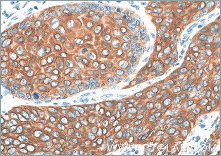 Immunohistochemical analysis of paraffin-embedded human oesophagus cancer tissue slide using anti-Cytokeratin 5 antibody (66727-1-Ig) labeled with FlexAble Biotin Antibody Labeling Kit for Mouse IgG1 (KFA027) and used at a dilution of 1:400 (under 10x lens & 40xlens). Streptavidin Poly-HRP and DAB substrate was used for detection. Heat mediated antigen retrieval performed with Tris-EDTA buffer (pH 9.0).