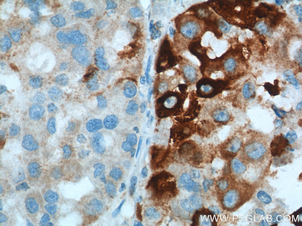 Immunohistochemical analysis of paraffin-embedded human liver cancer tissue slide using 10701-1-AP (HMOX1 antibody at dilution of 1:200 (under 40x lens). Heat mediated antigen retrieval with Tris-EDTA buffer (pH 9.0).