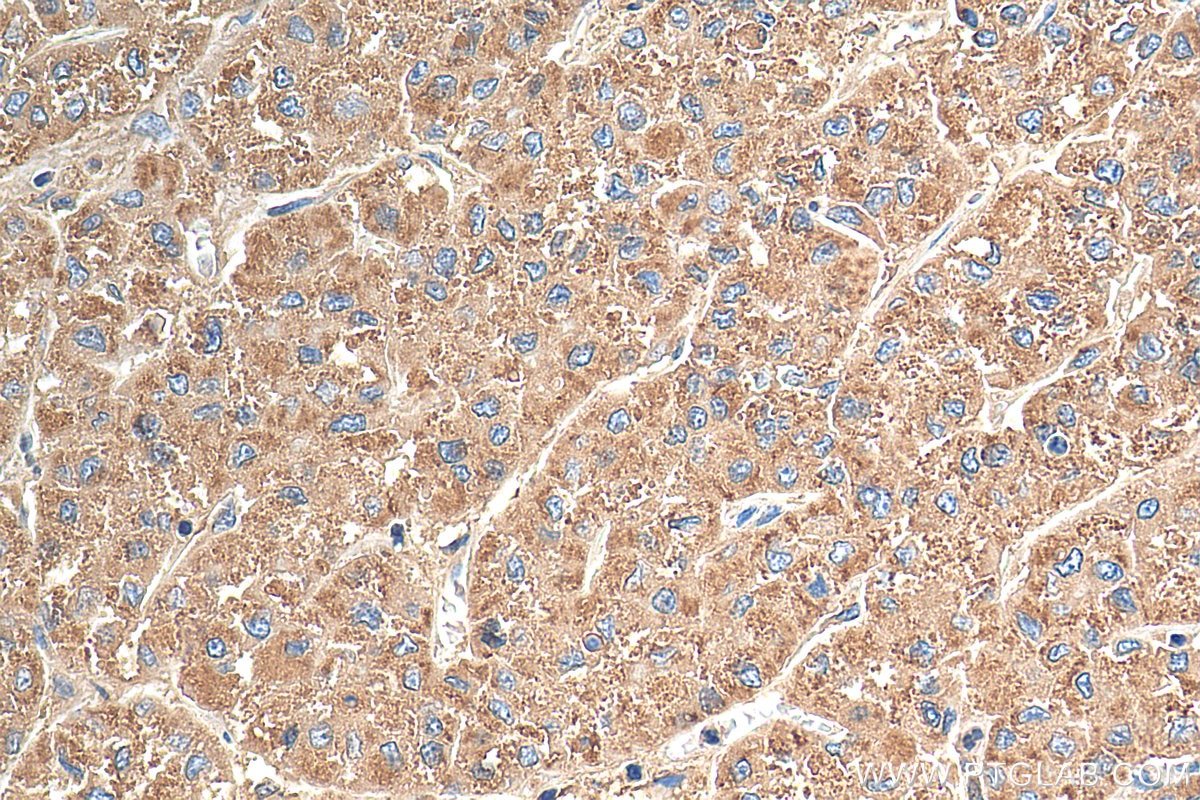 Immunohistochemical analysis of paraffin-embedded human liver cancer tissue slide using 21997-1-AP (LAMP1 antibody) at dilution of 1:200 (under 40x lens). Heat mediated antigen retrieval with Tris-EDTA buffer (pH 9.0).