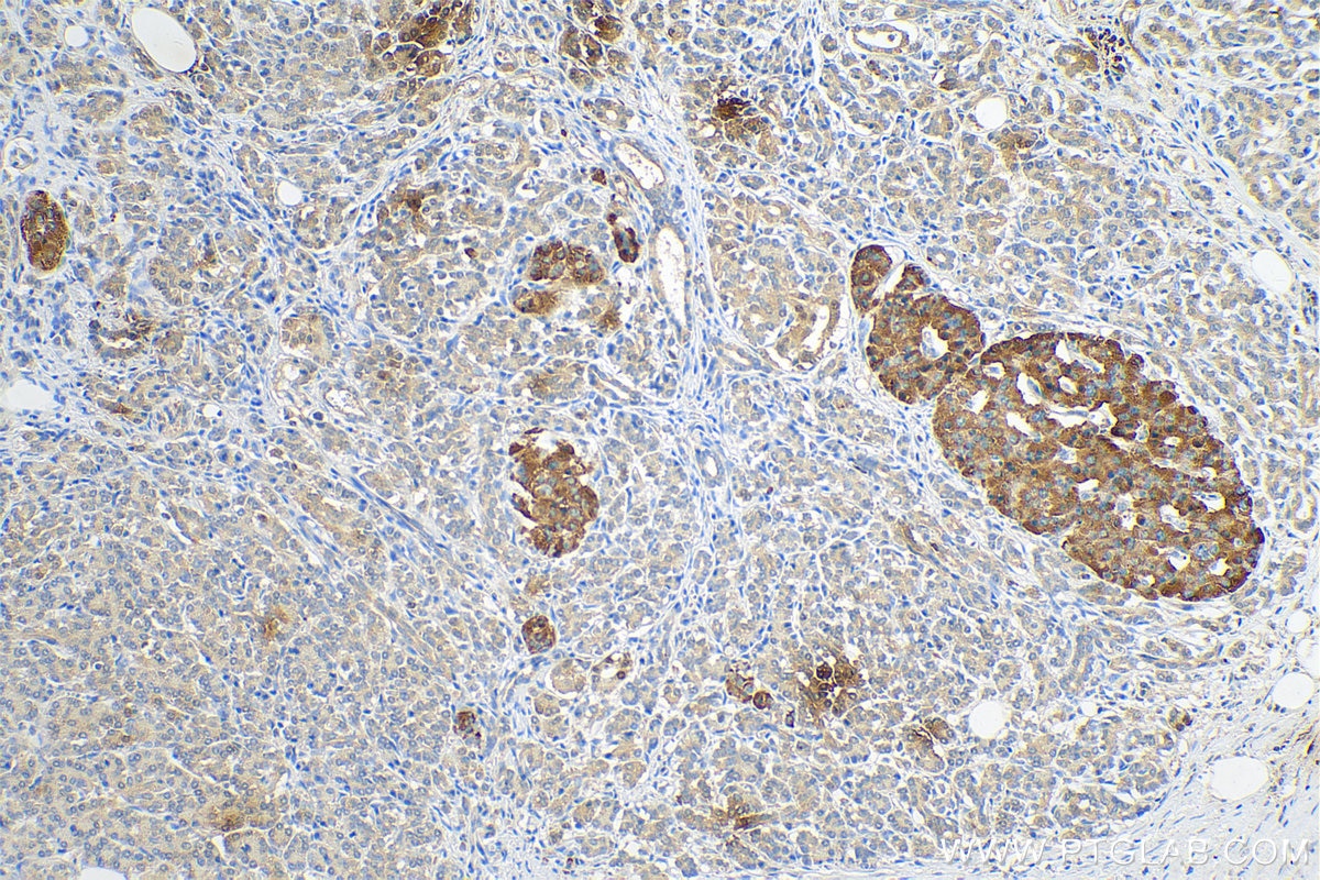 Immunohistochemical analysis of paraffin-embedded human pancreas cancer tissue slide using 80294-1-RR (P62,SQSTM1 antibody) at dilution of 1:200 (under 10x lens). Heat mediated antigen retrieval with Tris-EDTA buffer (pH 9.0).