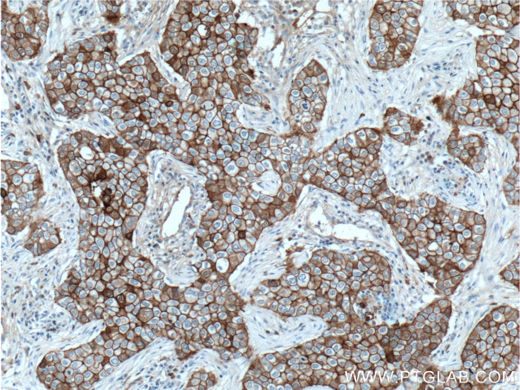 Immunohistochemical analysis of paraffin-embedded  human breast cancer tissue slide using 60335-1-Ig (E-cadherin antibody) at dilution of 1:2000 (under 10x lens. Heat mediated antigen retrieval with Tris-EDTA buffer (pH 9.0).