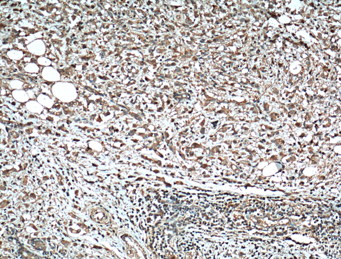 Immunohistochemical analysis of paraffin-embedded human breast cancer tissue slide using 66366-1-Ig (MMP2 antibody) at dilution of 1:300 (under 10x lens. Heat mediated antigen retrieval with Tris-EDTA buffer (pH 9.0).