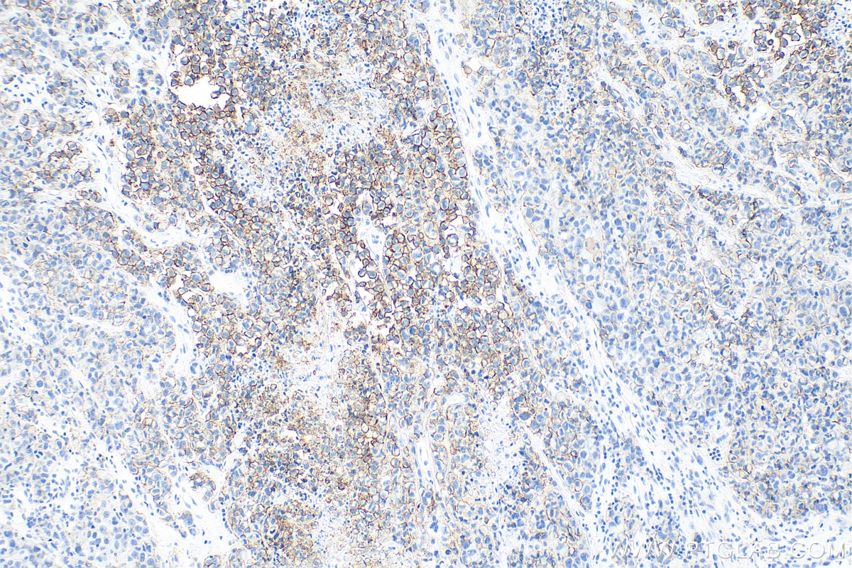 Immunohistochemical analysis of paraffin-embedded human malignant melanoma tissue slide using 66219-1-Ig (N-cadherin antibody) at dilution of 1:5000 (under 10x lens). Heat mediated antigen retrieval with Tris-EDTA buffer (pH 9.0).