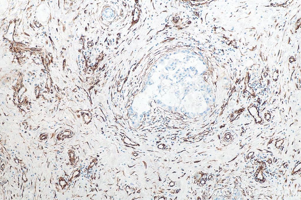 Immunohistochemical analysis of paraffin-embedded human breast cancer tissue slide using 80232-1-RR (Vimentin antibody) at dilution of 1:2500 (under 10x lens). Heat mediated antigen retrieval with Tris-EDTA buffer (pH 9.0).