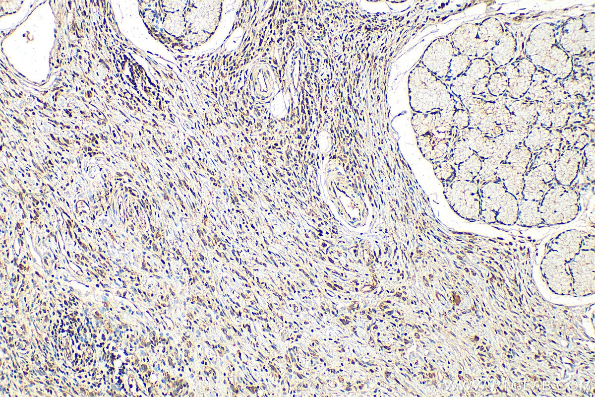Immunohistochemical analysis of paraffin-embedded human stomach cancer tissue slide using 13099-1-AP (SNAI1 antibody) at dilution of 1:200 (under 10x lens). Heat mediated antigen retrieval with Tris-EDTA buffer (pH 9.0).