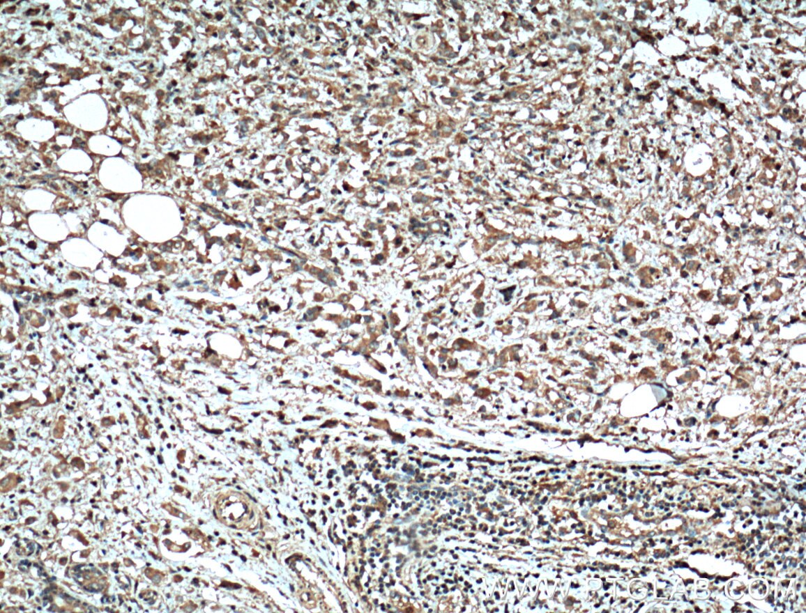 Immunohistochemical analysis of paraffin-embedded human breast cancer tissue slide using 66366-1-Ig (MMP2 antibody) at dilution of 1:300 (under 10x lens. Heat mediated antigen retrieval with Tris-EDTA buffer (pH 9.0).