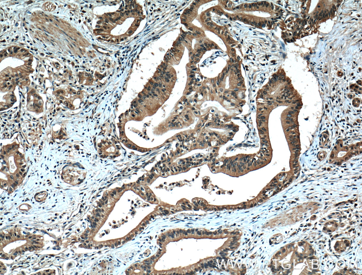 Immunohistochemical analysis of paraffin-embedded human pancreas cancer tissue slide using 66452-1-Ig (ZO-1 antibody) at dilution of 1:400 (under 10x lens. Heat mediated antigen retrieval with Tris-EDTA buffer (pH 9.0).