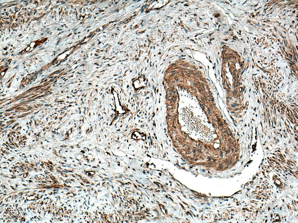 Immunohistochemical analysis of paraffin-embedded human cervical cancer tissue slide using 10375-2-AP (MMP9 (N-terminal) antibody) at dilution of 1:200 (under 10x lens). Heat mediated antigen retrieval with Tris-EDTA buffer (pH 9.0).
