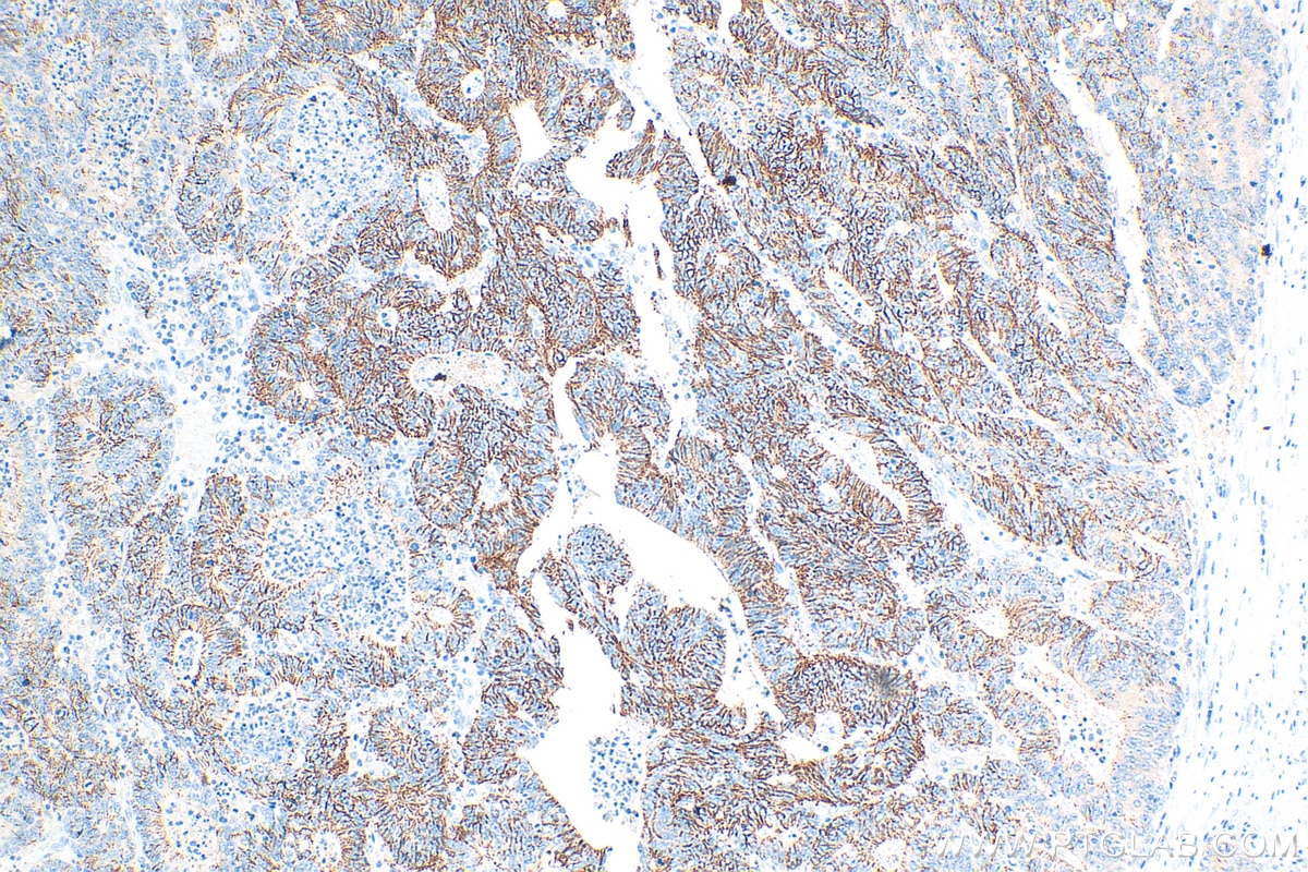 Immunohistochemical analysis of paraffin-embedded human skin cancer tissue slide using 13050-1-AP (Claudin 1 antibody) at dilution of 1:1000 (under 10x lens). Heat mediated antigen retrieval with Tris-EDTA buffer (pH 9.0).