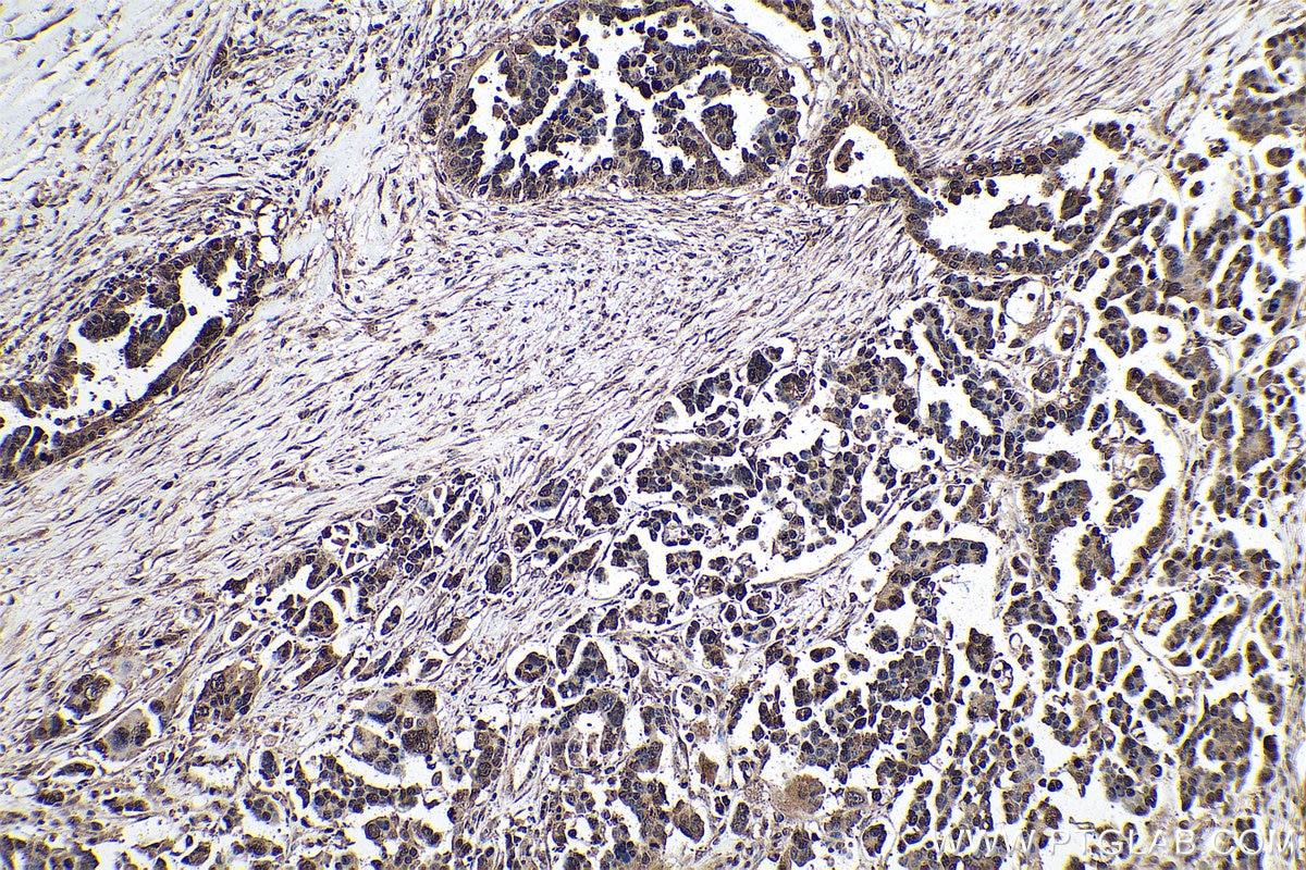 Immunohistochemical analysis of paraffin-embedded human colon cancer tissue slide using 68302-1-Ig (m7G antibody) at dilution of 1:2000 (under 10x lens). Heat mediated antigen retrieval with Tris-EDTA buffer (pH 9.0).