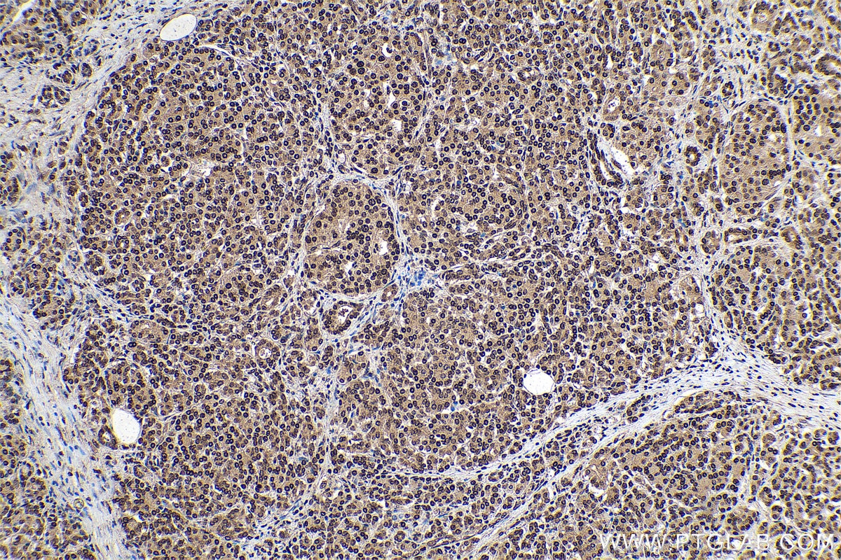 Immunohistochemical analysis of paraffin-embedded human pancreas cancer tissue slide using 68302-1-Ig (m7G antibody) at dilution of 1:2000 (under 10x lens). Heat mediated antigen retrieval with Tris-EDTA buffer (pH 9.0).