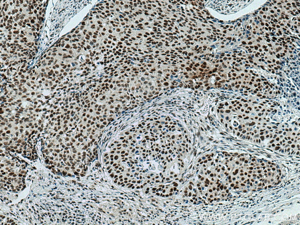 Immunohistochemical analysis of paraffin-embedded human oesophagus cancer tissue slide using 66580-1-Ig (NSUN2 antibody) at dilution of 1:2000 (under 10x lens). Heat mediated antigen retrieval with Tris-EDTA buffer (pH 9.0).