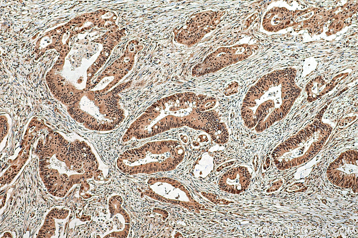 Immunohistochemical analysis of paraffin-embedded human colon cancer tissue slide using 21207-1-AP (TET2 antibody) at dilution of 1:500 (under 10x lens). Heat mediated antigen retrieval with Tris-EDTA buffer (pH 9.0).