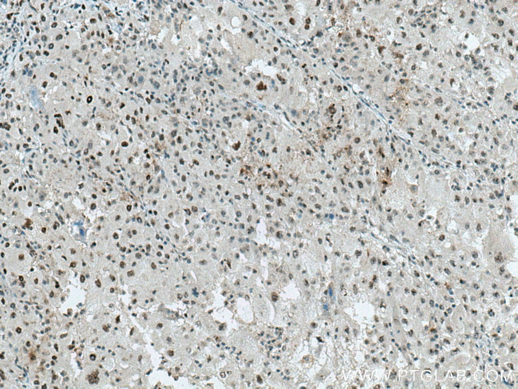 Immunohistochemical analysis of paraffin-embedded human liver cancer tissue slide using 16690-1-AP (ALY antibody) at dilution of 1:200 (under 10x lens). Heat mediated antigen retrieval with Tris-EDTA buffer (pH 9.0).