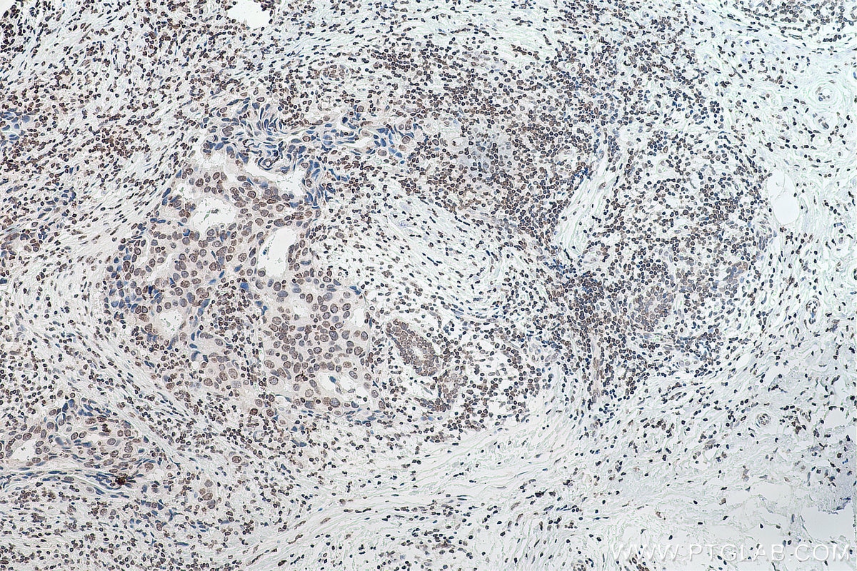 Immunohistochemical analysis of paraffin-embedded human breast cancer tissue slide using 68055-1-Ig (m6A antibody) at dilution of 1:4000 (under 10x lens). Heat mediated antigen retrieval with Tris-EDTA buffer (pH 9.0).