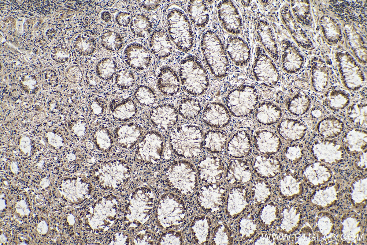 Immunohistochemical analysis of paraffin-embedded human colon cancer tissue slide using 80790-1-RR (METTL14 antibody) at dilution of 1:2000 (under 10x lens). Heat mediated antigen retrieval with Tris-EDTA buffer (pH 9.0).