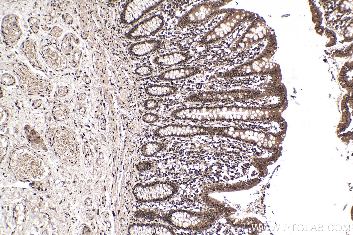Immunohistochemical analysis of paraffin-embedded human colon tissue slide using 60188-1-Ig (WTAP antibody) at dilution of 1:1000 (under 10x lens). Heat mediated antigen retrieval with Tris-EDTA buffer (pH 9.0).