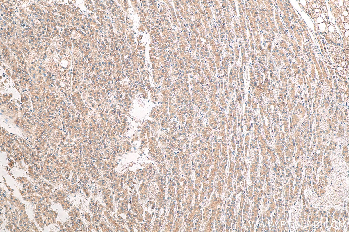 Immunohistochemical analysis of paraffin-embedded human liver cancer tissue slide using 81471-1-RR (FTO antibody) at dilution of 1:1000 (under 10x lens). Heat mediated antigen retrieval with Tris-EDTA buffer (pH 9.0).