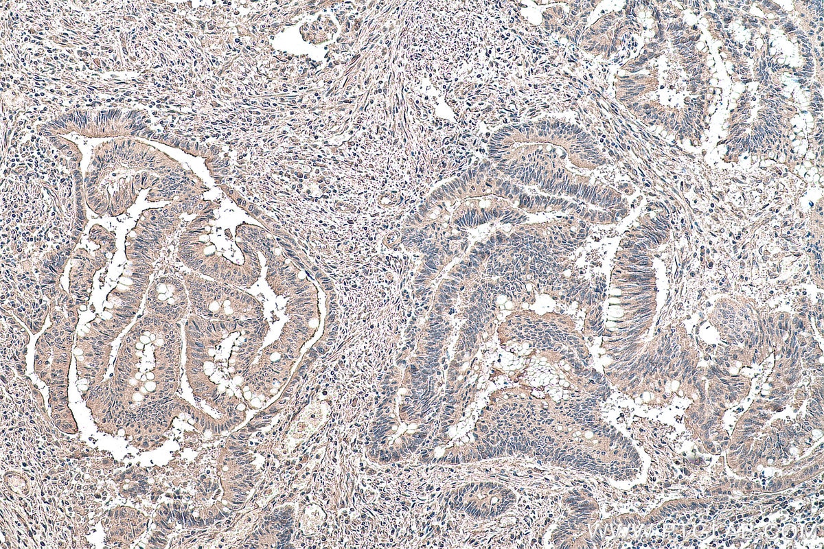Immunohistochemical analysis of paraffin-embedded human colon cancer tissue slide using 66745-1-Ig (YTHDF1 antibody) at dilution of 1:2000 (under 10x lens). Heat mediated antigen retrieval with Tris-EDTA buffer (pH 9.0).