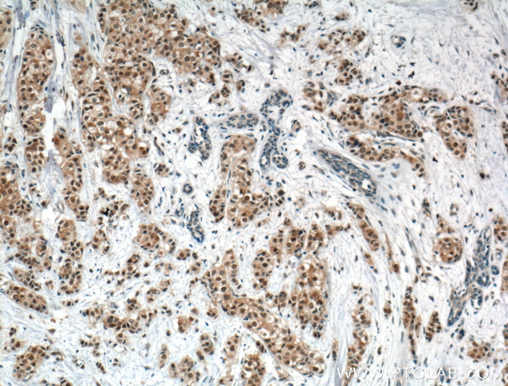 Immunohistochemical analysis of paraffin-embedded human breast cancer tissue slide using 60203-2-Ig (AKT Antibody) at dilution of 1:200 (under 10x lens). Heat mediated antigen retrieval with Tris-EDTA buffer (pH 9.0).