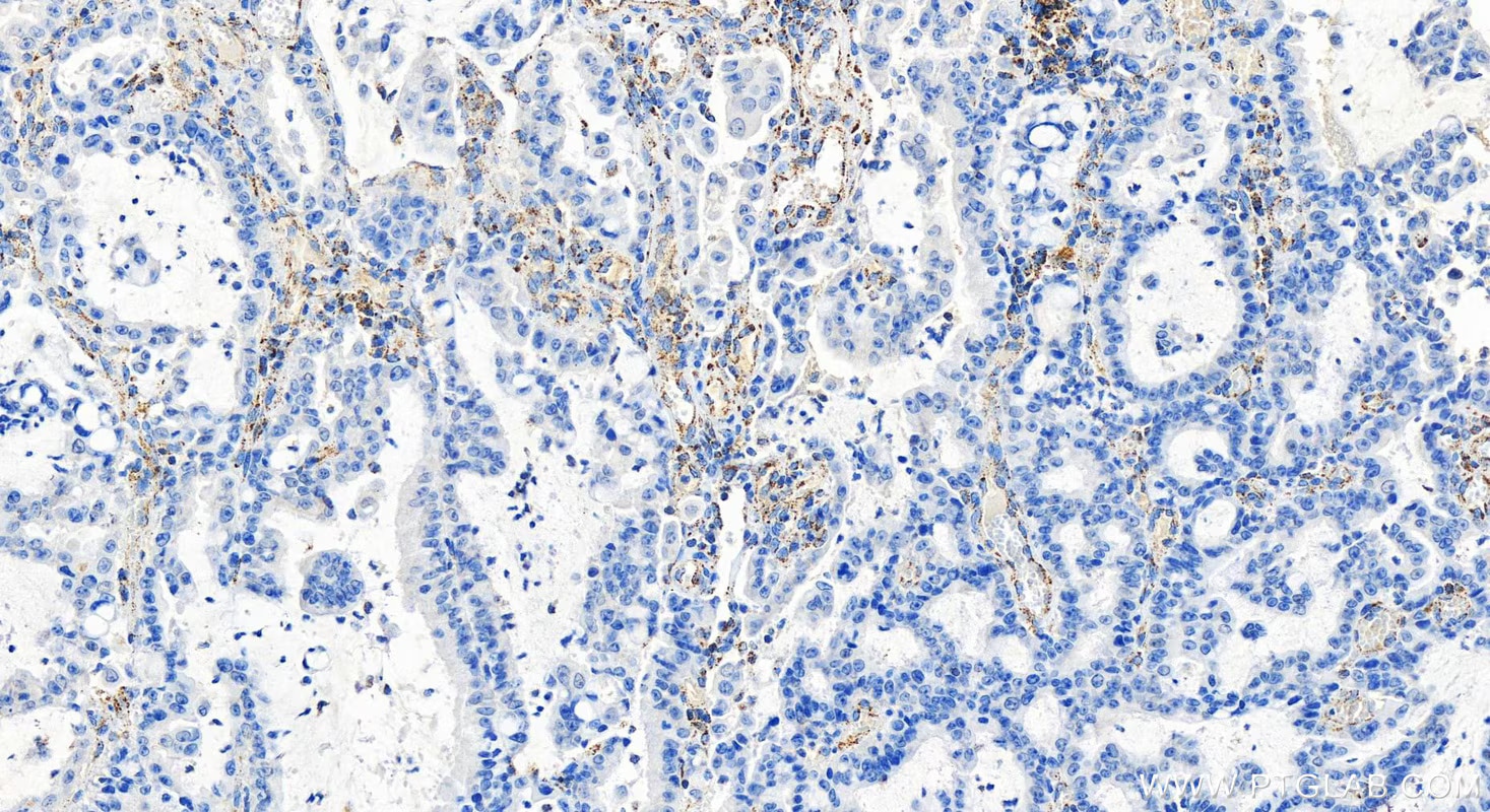Immunohistochemical analysis of paraffin-embedded human stomach cancer tissue slide using 83654-3-RR (DLAT antibody) at dilution of 1:500 (under 20x lens). Heat mediated antigen retrieval with Tris-EDTA buffer(pH9).