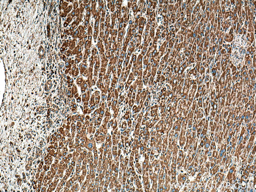 Immunohistochemical analysis of paraffin-embedded human liver cancer tissue slide using 67702-1-Ig (DLD antibody) at dilution of 1:500 (under 10x lens). Heat mediated antigen retrieval with Tris-EDTA buffer (pH 9.0).