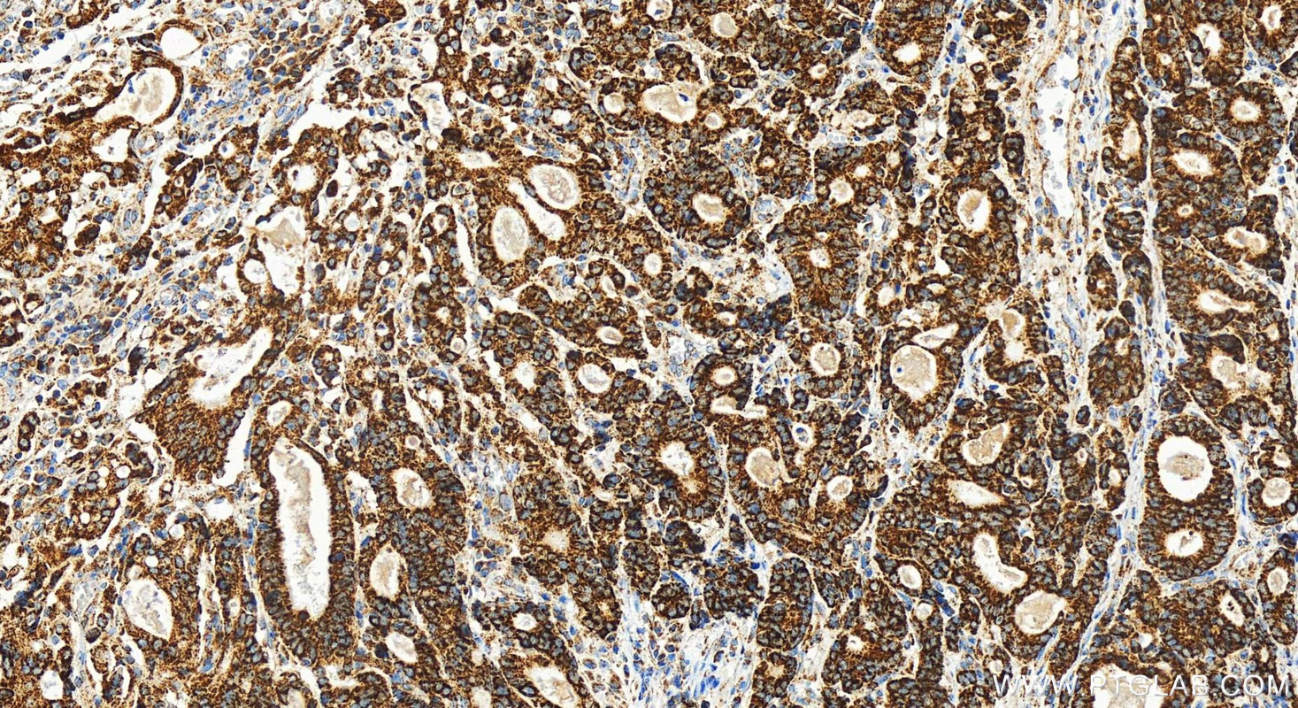 Immunohistochemical analysis of paraffin-embedded human stomach cancer tissue slide using 82957-2-RR (FDX1 antibody) at dilution of 1:400 (under 20x lens). Heat mediated antigen retrieval with Tris-EDTA buffer(pH9).