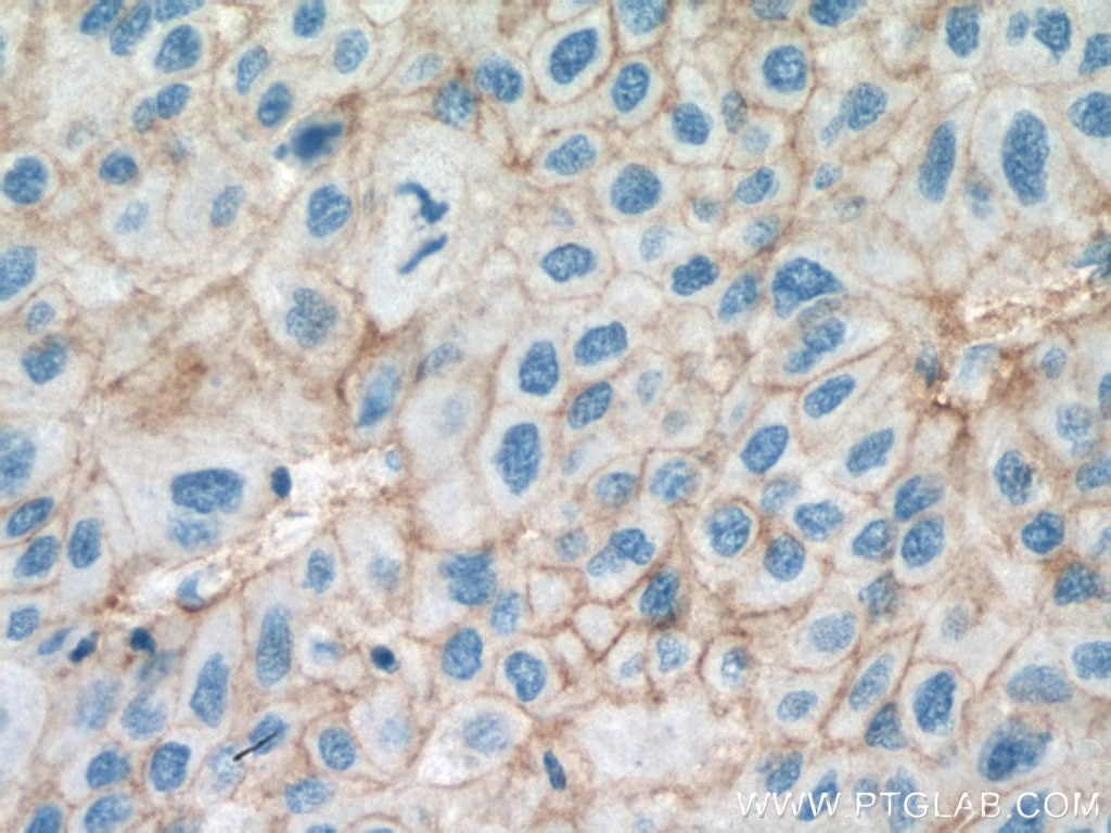 Immunohistochemical analysis of paraffin-embedded human liver cancer tissue slide using 67221-1-Ig (SLC31A1 antibody) at dilution of 1:2000 (under 40x lens). Heat mediated antigen retrieval with Tris-EDTA buffer (pH 9.0).