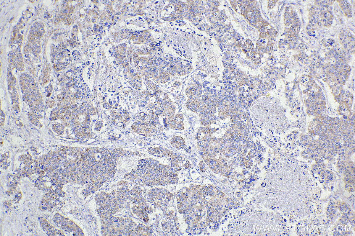 Immunohistochemical analysis of paraffin-embedded human stomach cancer tissue slide using 12451-1-AP (DBT antibody) at dilution of 1:1000 (under 10x lens). Heat mediated antigen retrieval with Tris-EDTA buffer (pH 9.0).