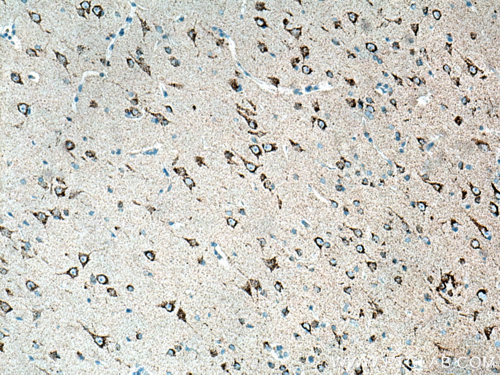 Immunohistochemical analysis of paraffin-embedded human gliomas tissue slide using 12855-1-AP (KGA/GAC antibody) at dilution of 1:200 (under 10x lens). Heat mediated antigen retrieval with Tris-EDTA buffer (pH 9.0).