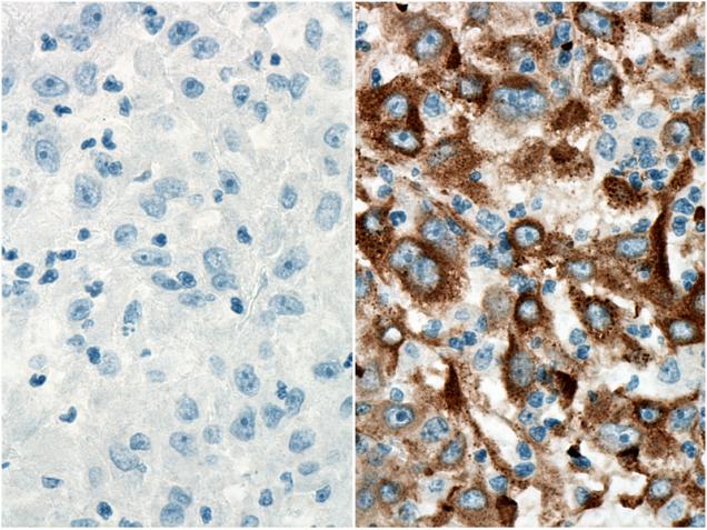 Immunohistochemistry analysis of paraffin-embedded human liver cancer tissue slide using PR30012 without (left) or with (right) primary antibody.