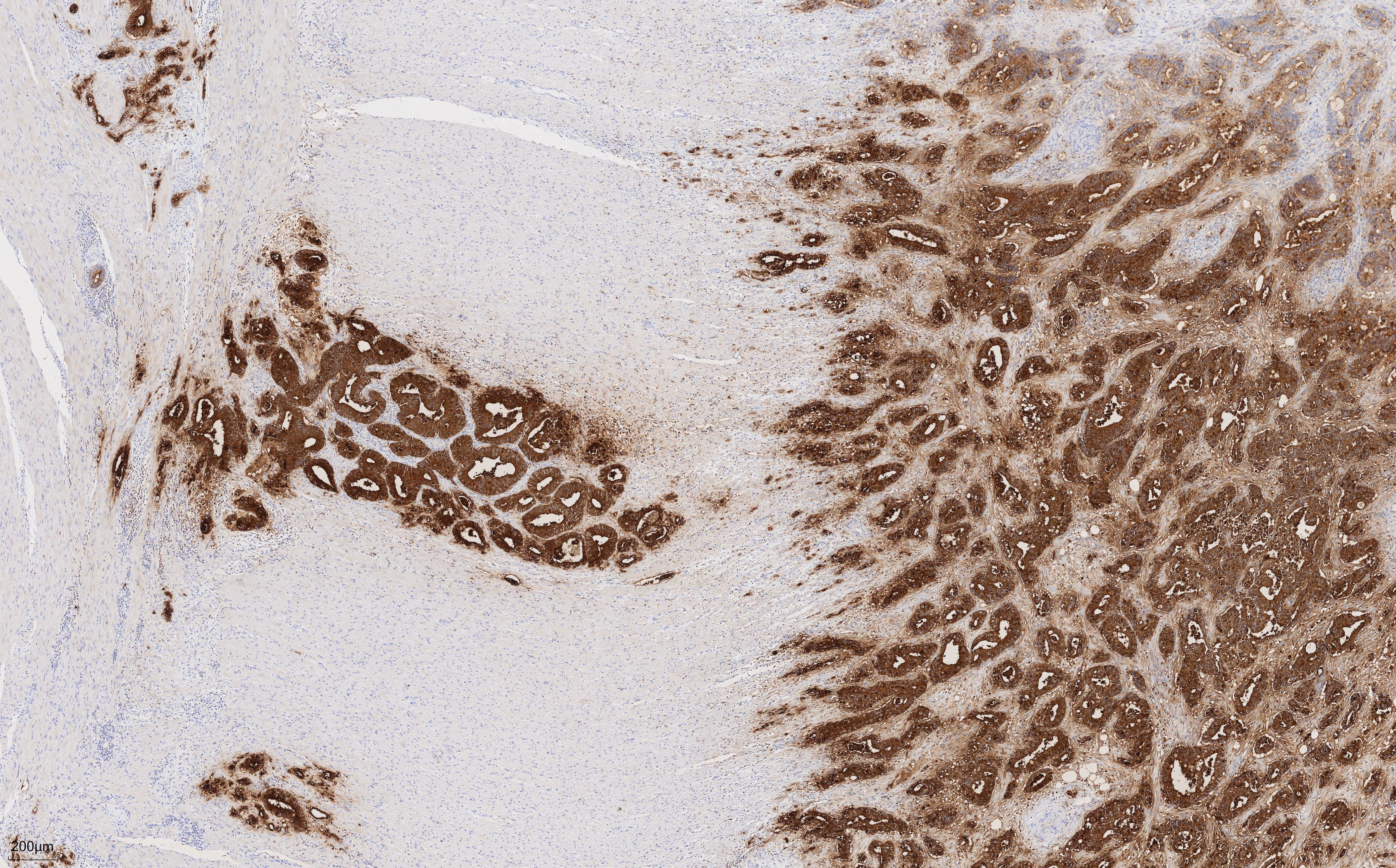 Immunohistochemistry of 68377-1-Ig (CEA mouse monoclonal antibody, 1:2000) in human rectal cancer tissue. PR30018 (DAB) was used as substrate.